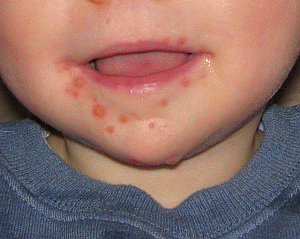 Image: Hand Foot and Mouth Disease